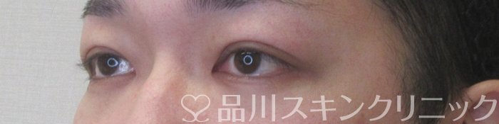 症例NO.74410のAFTER写真