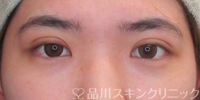 症例NO.73234のAFTER写真