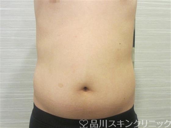 症例NO.34723のBEFORE写真