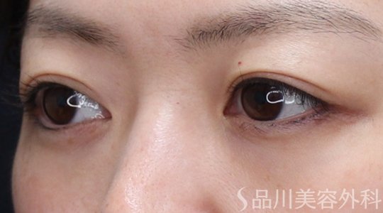 症例NO.74047のBEFORE写真