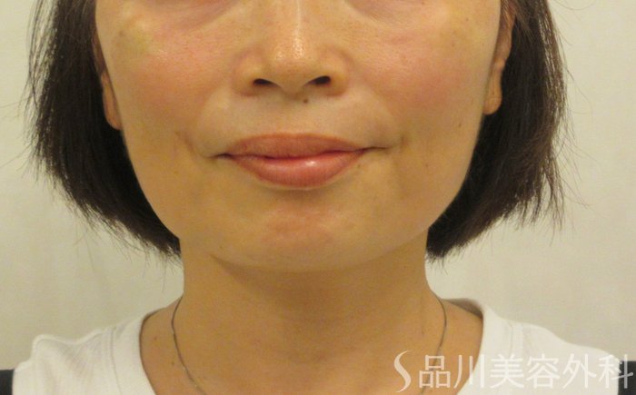 症例NO.71567のAFTER写真