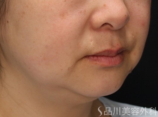 症例NO.74350のBEFORE写真