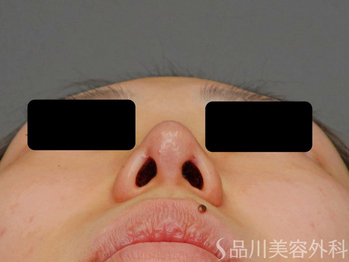 症例NO.73593のAFTER写真