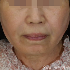 症例NO.71030のAFTER写真