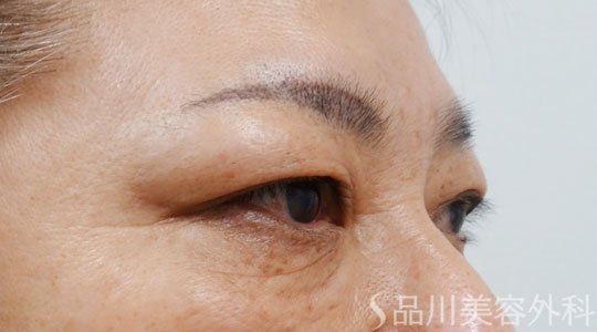 症例NO.69407のBEFORE写真