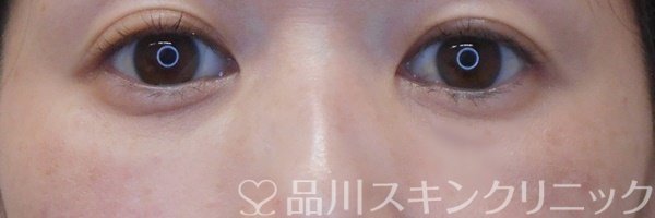 症例NO.73144のAFTER写真