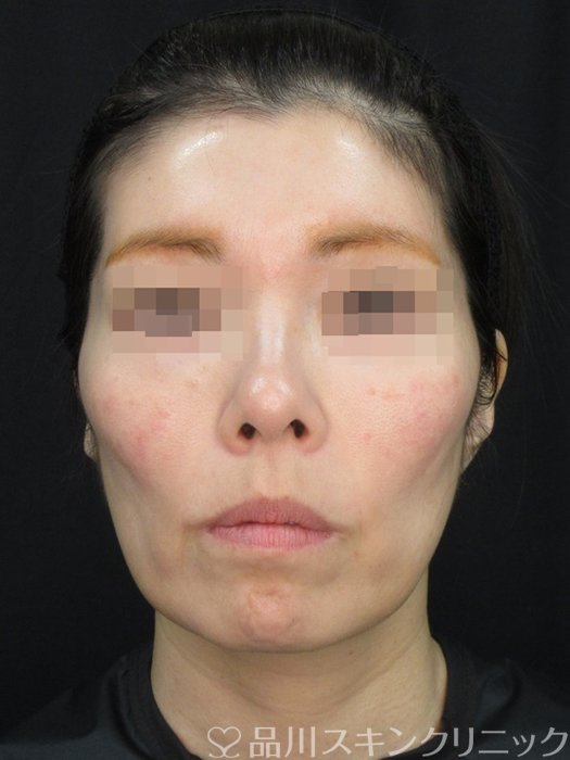 症例NO.72462のAFTER写真