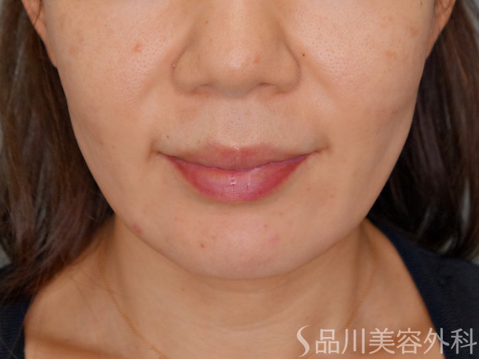 症例NO.70061のBEFORE写真