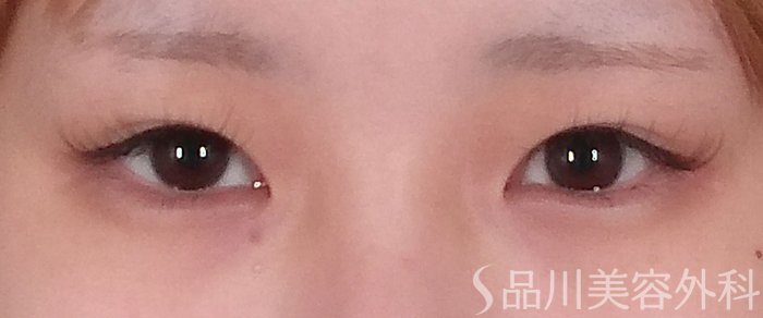症例NO.69976のBEFORE写真