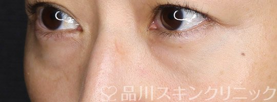 症例NO.66017のBEFORE写真