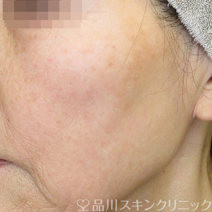 症例NO.75159のBEFORE写真