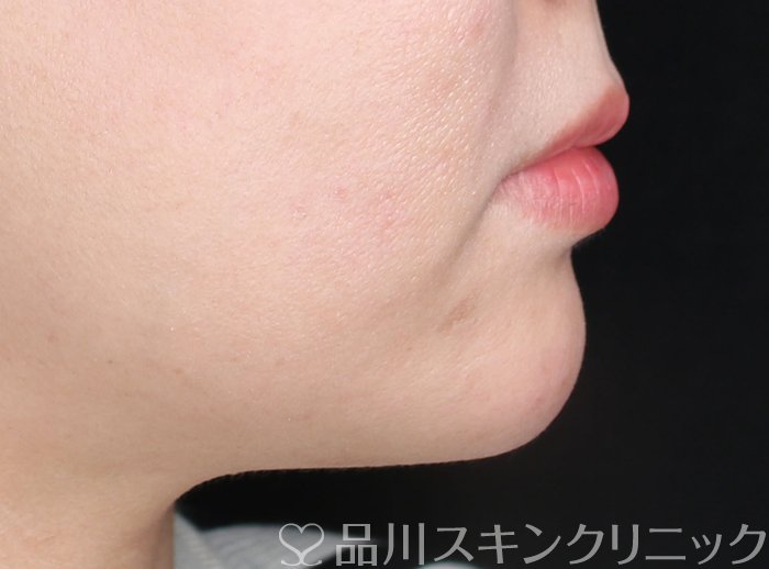 症例NO.73596のAFTER写真