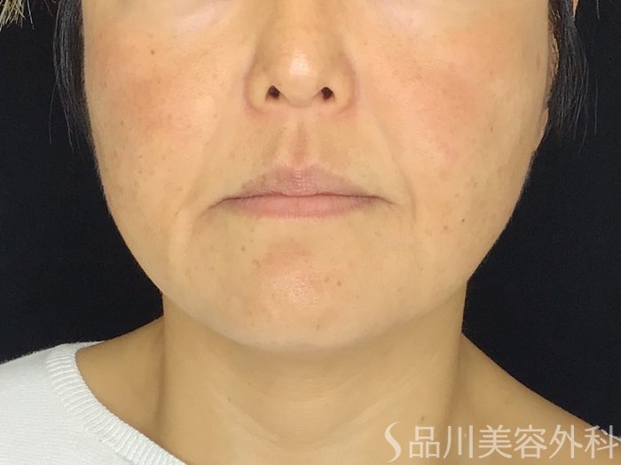 症例NO.67882のBEFORE写真
