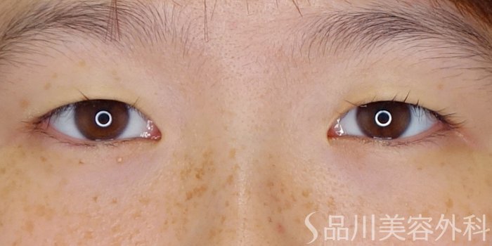 症例NO.70262のBEFORE写真