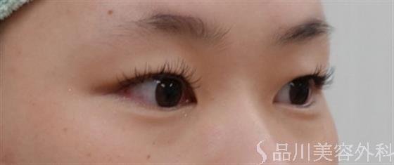 症例NO.36923のBEFORE写真
