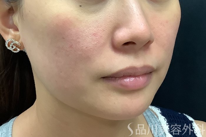 症例NO.71581のBEFORE写真