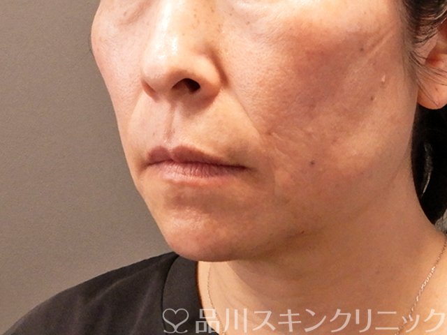 症例NO.70858のBEFORE写真