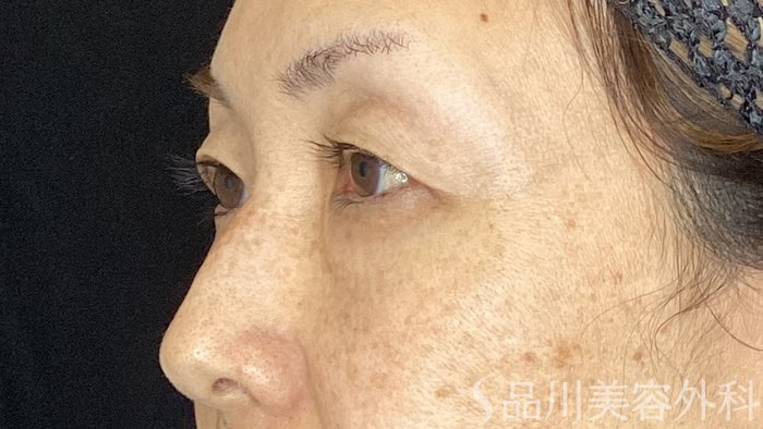 症例NO.67726のBEFORE写真