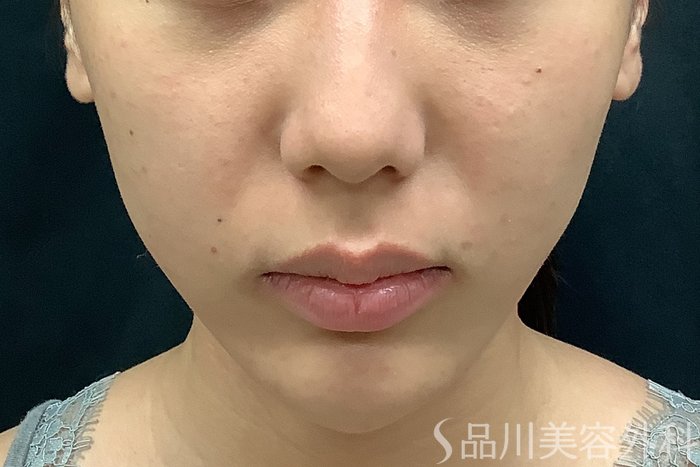 症例NO.67783のBEFORE写真
