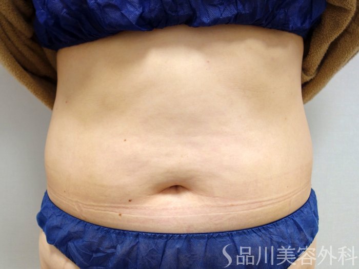 症例NO.65557のBEFORE写真