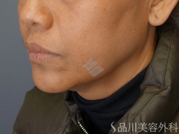 症例NO.72276のAFTER写真