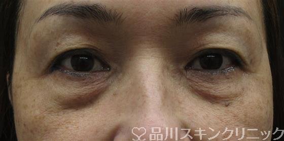 症例NO.61367のBEFORE写真