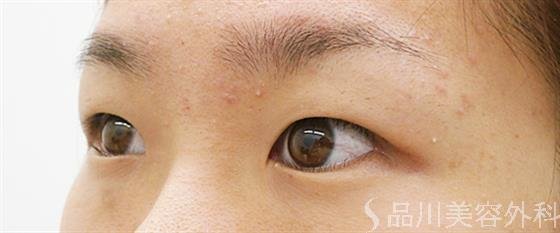 症例NO.25020のBEFORE写真