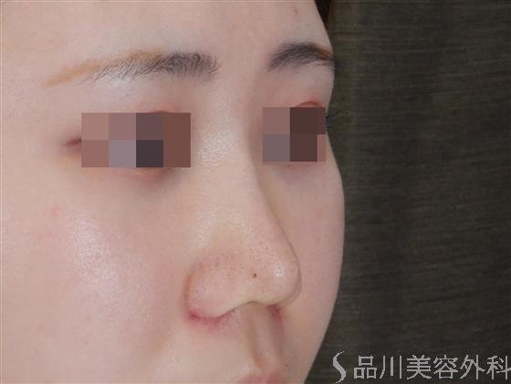 症例NO.60038のAFTER写真