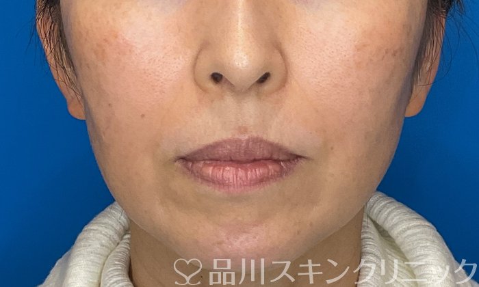 症例NO.74453のBEFORE写真