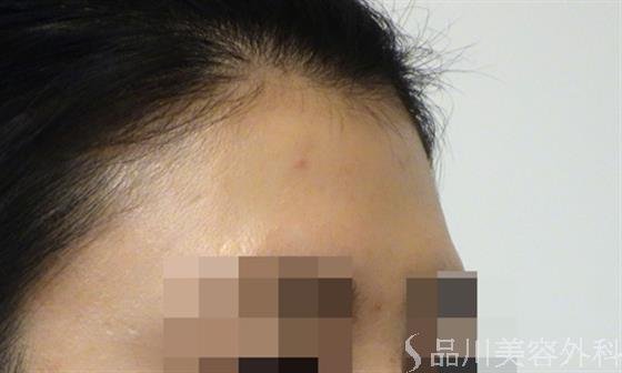 症例NO.47181のBEFORE写真