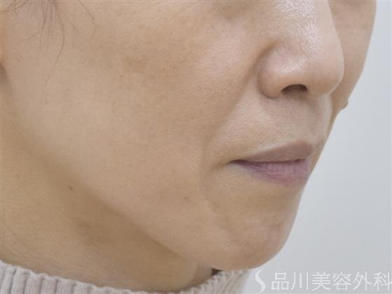 症例NO.51124のBEFORE写真