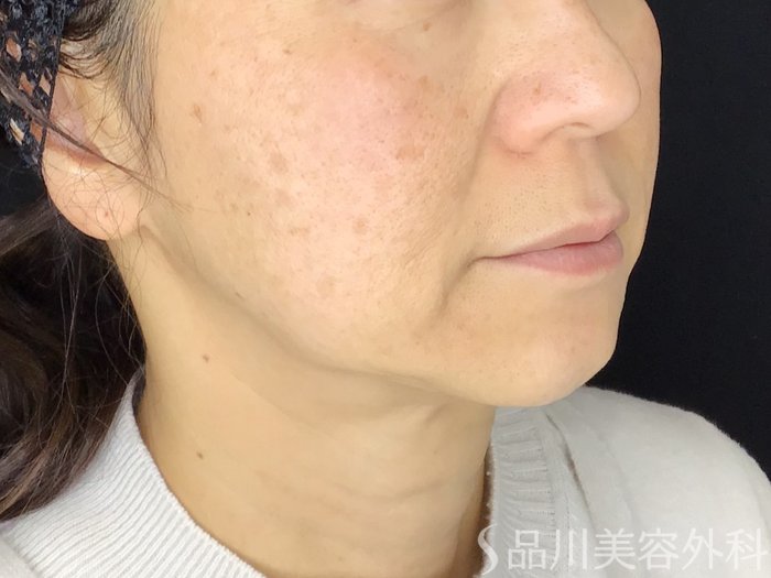 症例NO.69592のBEFORE写真