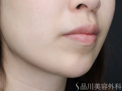 症例NO.73070のAFTER写真