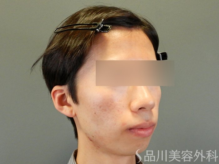 症例NO.65027のAFTER写真