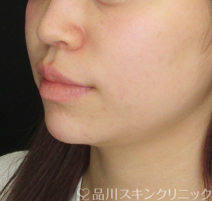 症例NO.74821のAFTER写真