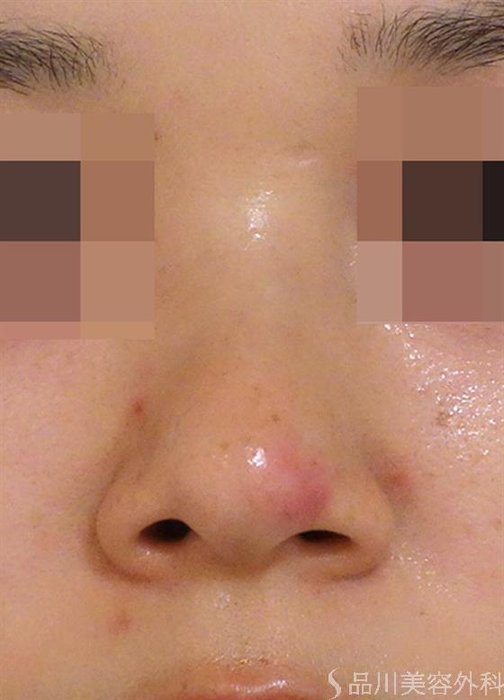 症例NO.40180のBEFORE写真