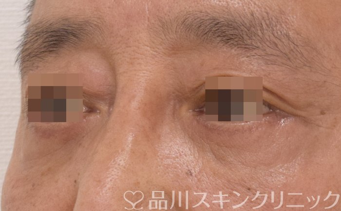 症例NO.70793のAFTER写真