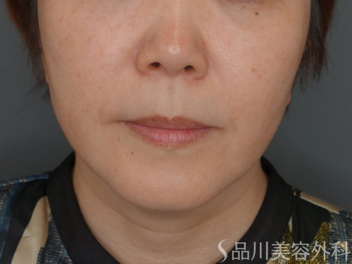 症例NO.75321のBEFORE写真