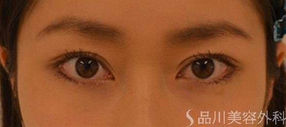 症例NO.18943のAFTER写真