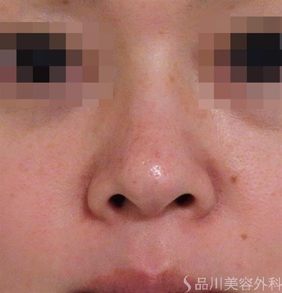 症例NO.38088のBEFORE写真