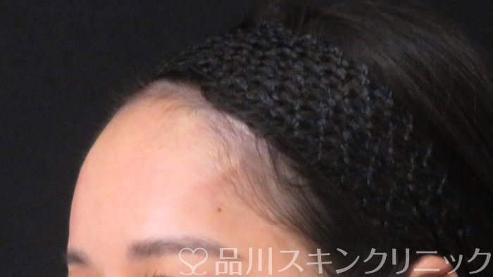 症例NO.70862のAFTER写真