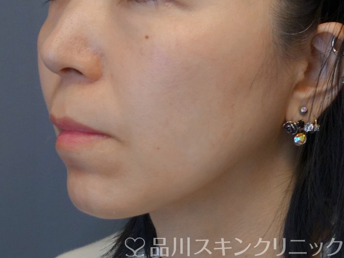 症例NO.73890のAFTER写真