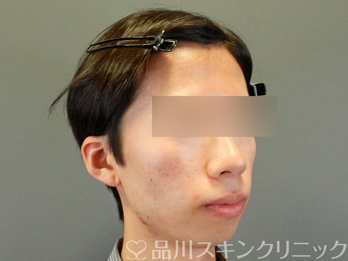症例NO.65027のAFTER写真