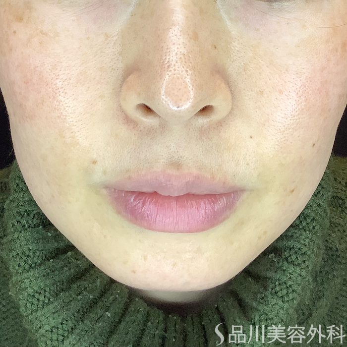 症例NO.62085のBEFORE写真