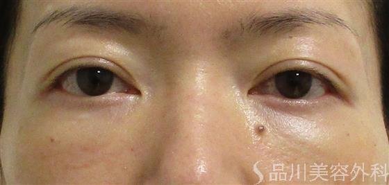 症例NO.59150のAFTER写真