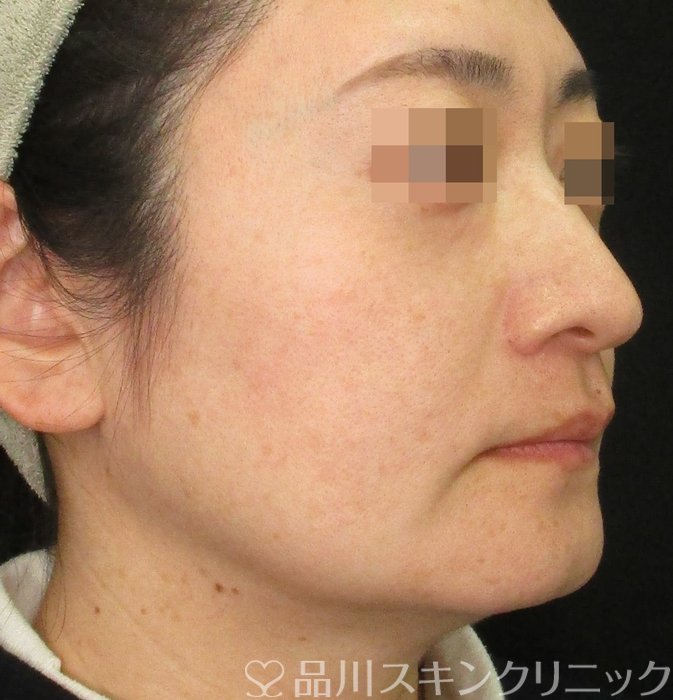 症例NO.74217のBEFORE写真