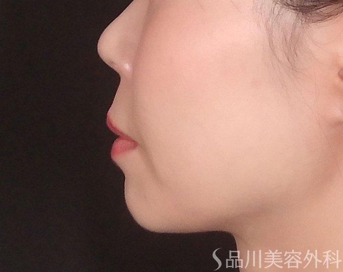 症例NO.70458のBEFORE写真