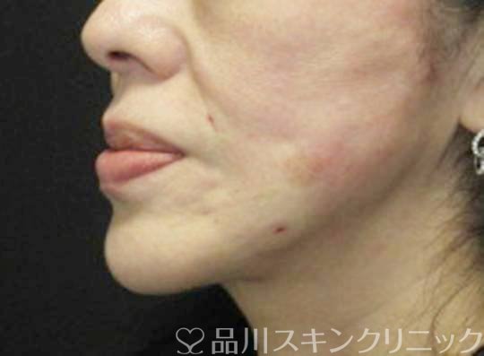症例NO.72383のAFTER写真