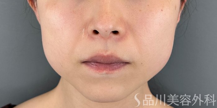 症例NO.71077のBEFORE写真