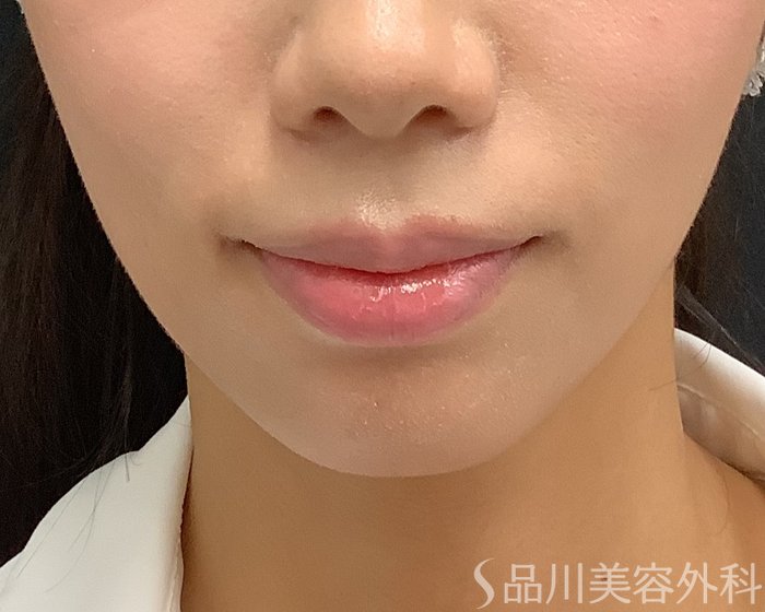 症例NO.75339のBEFORE写真